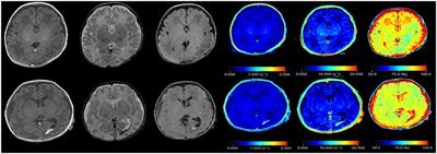 The Effect of Intraventricular Hemorrhage on Brain Development in Premature Infants: A Synthetic MRI Study